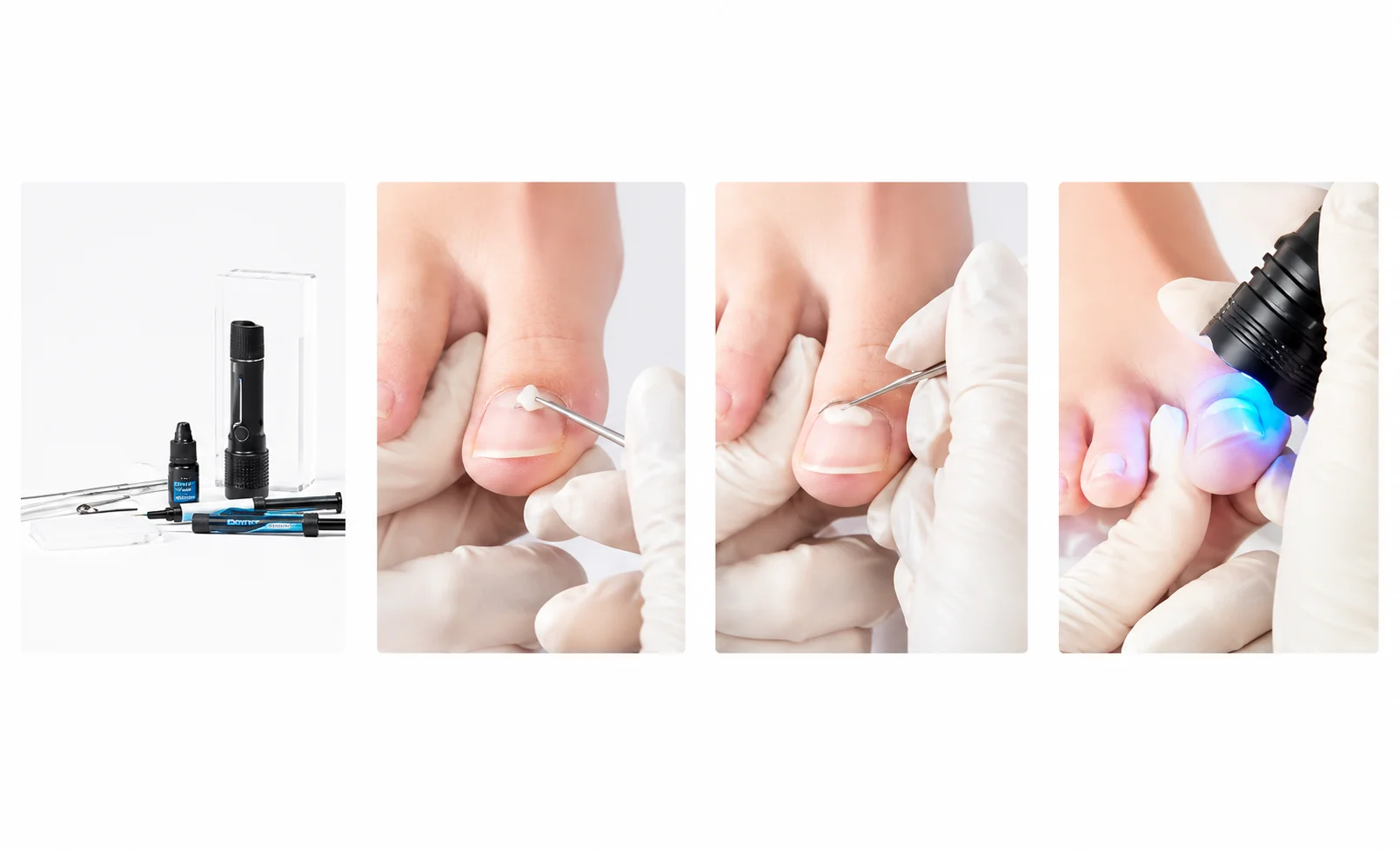 Onyfix Step by Step 1